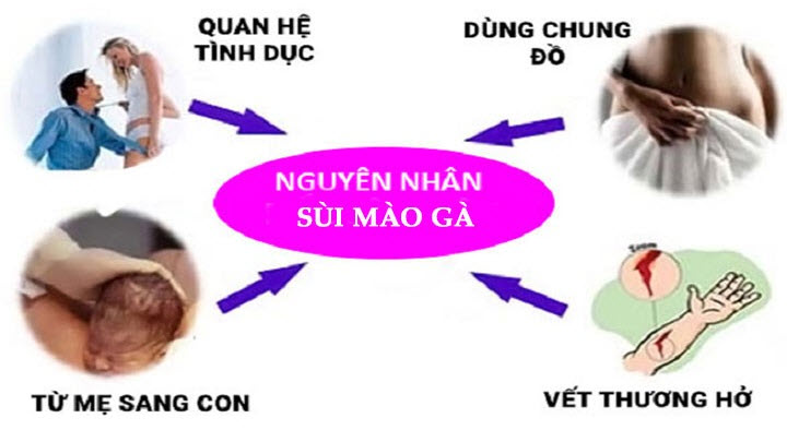 Biến chứng của sùi mào gà có thể gây ung thư dương vật không?