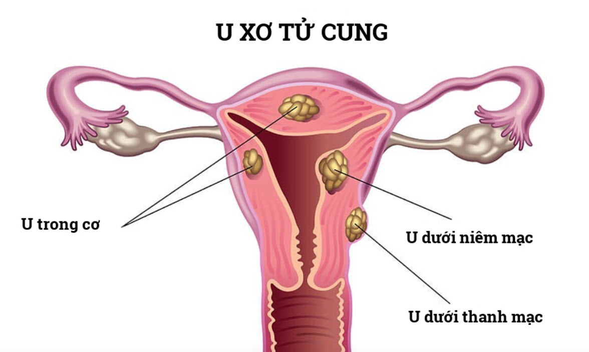 U xơ tử cung là gì? Biến Chứng Có Gây Ung Thư Không? Kích Thước Bao Nhiêu Là To?