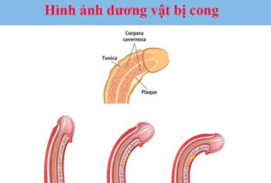 Dương vật cong có ảnh hưởng gì không? có quan hệ được không?