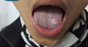 Sùi mào gà ở miệng trẻ em có dấu hiệu gì? chữa ở đâu tại Vinh Nghệ An uy tín 12