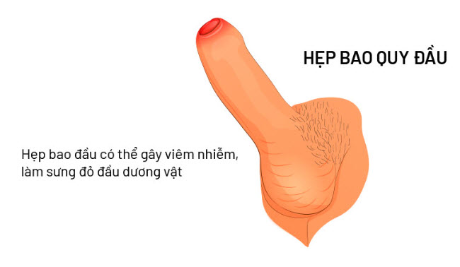 Hẹp Bao Quy Đầu Có Quan Hệ Được Không? Có Bị Ảnh Hưởng Gì Không? 1